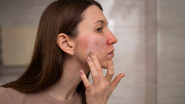 АЛЕРГИИ: КАК ДА ЗАЩИТИТЕ КОЖАТА СИ ПО ВРЕМЕ НА СЕЗОНА НА ПОЛЕНИТЕ? (2-3 МИНУТИ ЧЕТЕНЕ)