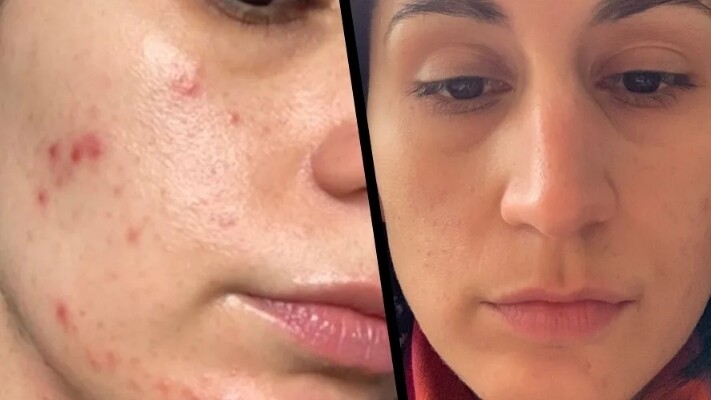 Nejoblíbenější terapie proti vráskám i akné? Galvanizace pleti